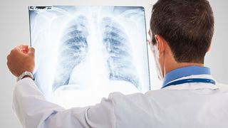 Arzt schaut auf Röntgenbild der Lunge